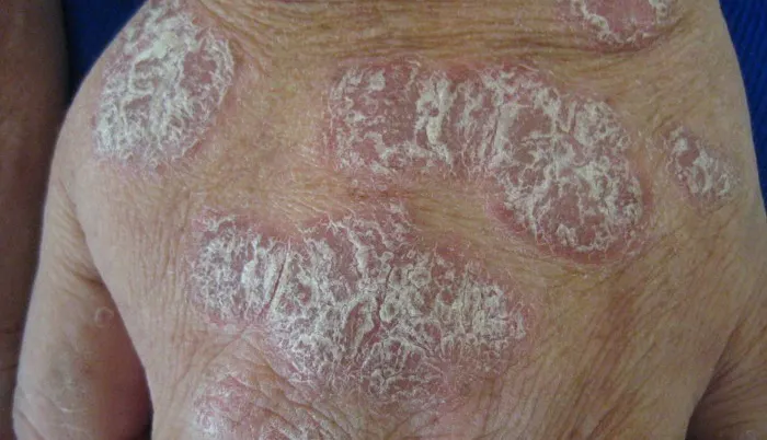 Plaque Psoriasis Symptoms Causes Treatment plaque-psoriasis-symptoms-causes-treatment